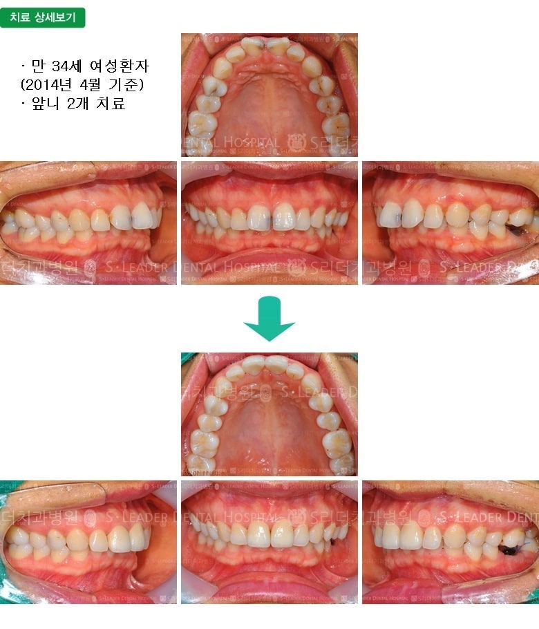 상악 앞니 2개 — 추가 사진 (심미보철)