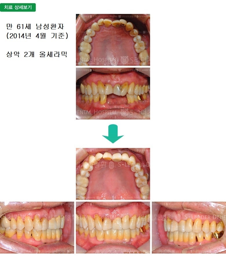 만 61세 남성환자, 앞니2개 치료 — 추가 사진 (심미보철)