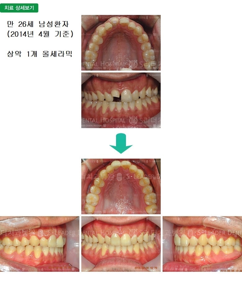 부러진 앞니의 치료, 만26세 남성환자 — 추가 사진 (심미보철)