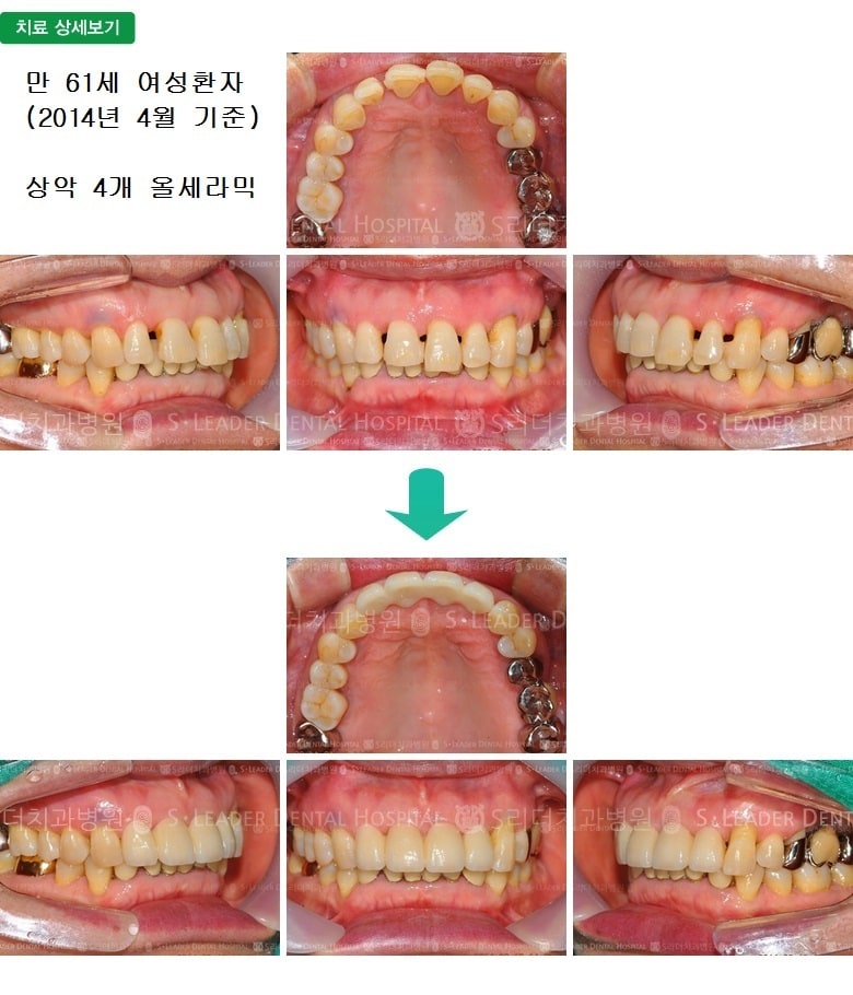 만 61세 여성환자, 앞니4개 치료 — 추가 사진 (심미보철)