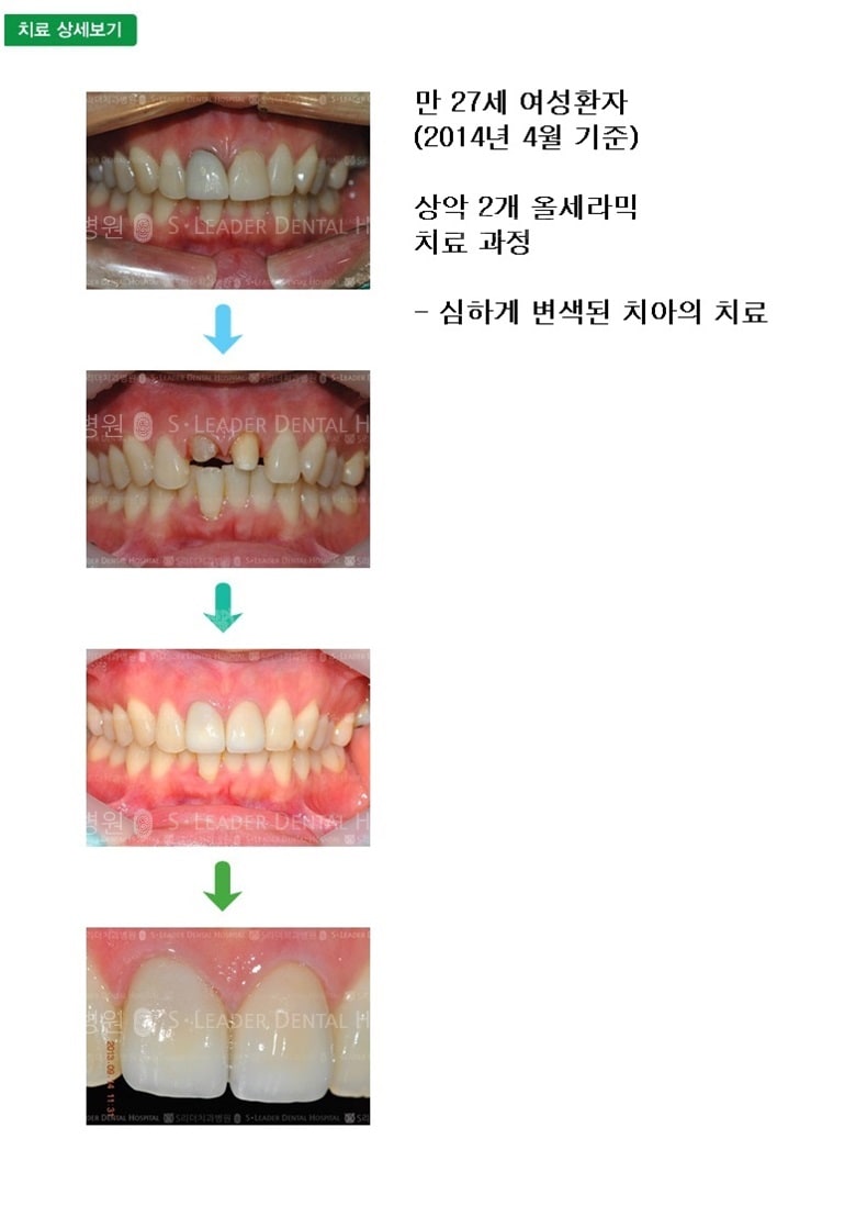 만 27세 여성환자, 앞니 2개 치료 — 추가 사진 (심미보철)