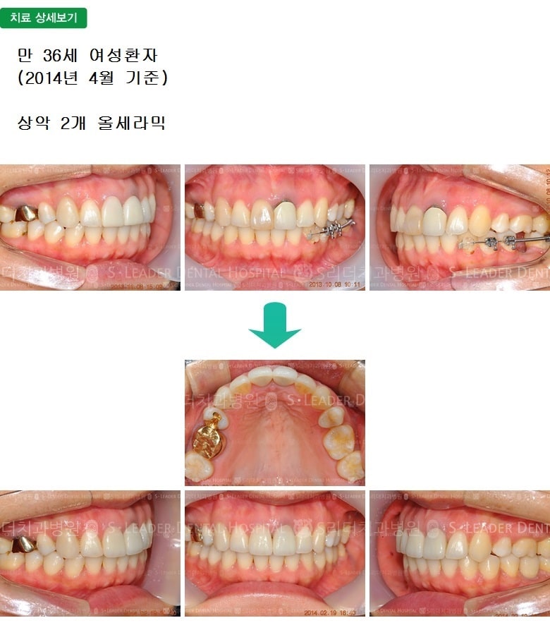 변색된 앞니의 치료, 만36세 여성환자 — 추가 사진 (심미보철)