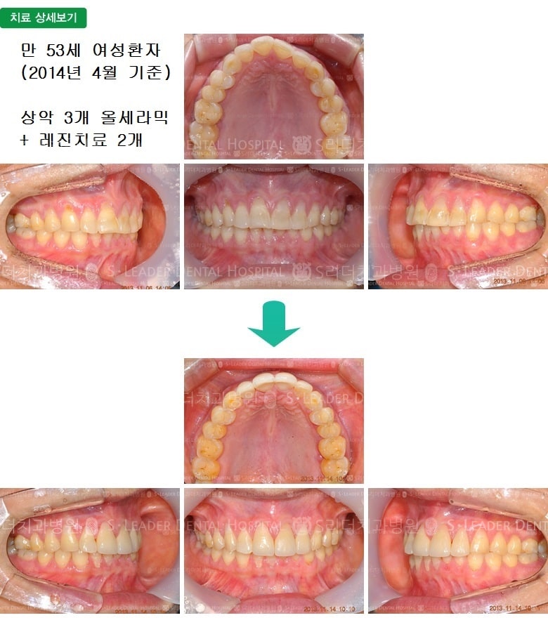 만 53세 여성환자, 윗니3개+레진1개 — 추가 사진 (심미보철)