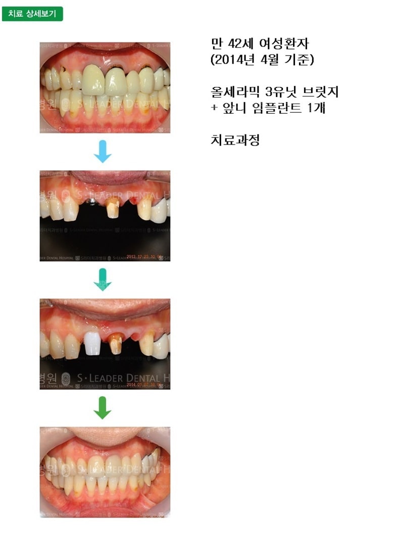 만 42세 여성환자, 올세라믹 브릿지+임플란트 — 추가 사진 (심미보철)