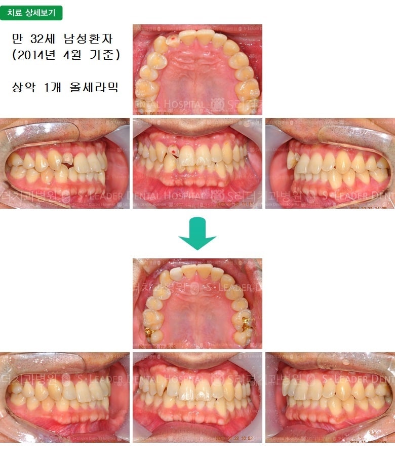 부러진 앞니의 치료, 만32세 남성환자 — 추가 사진 (심미보철)