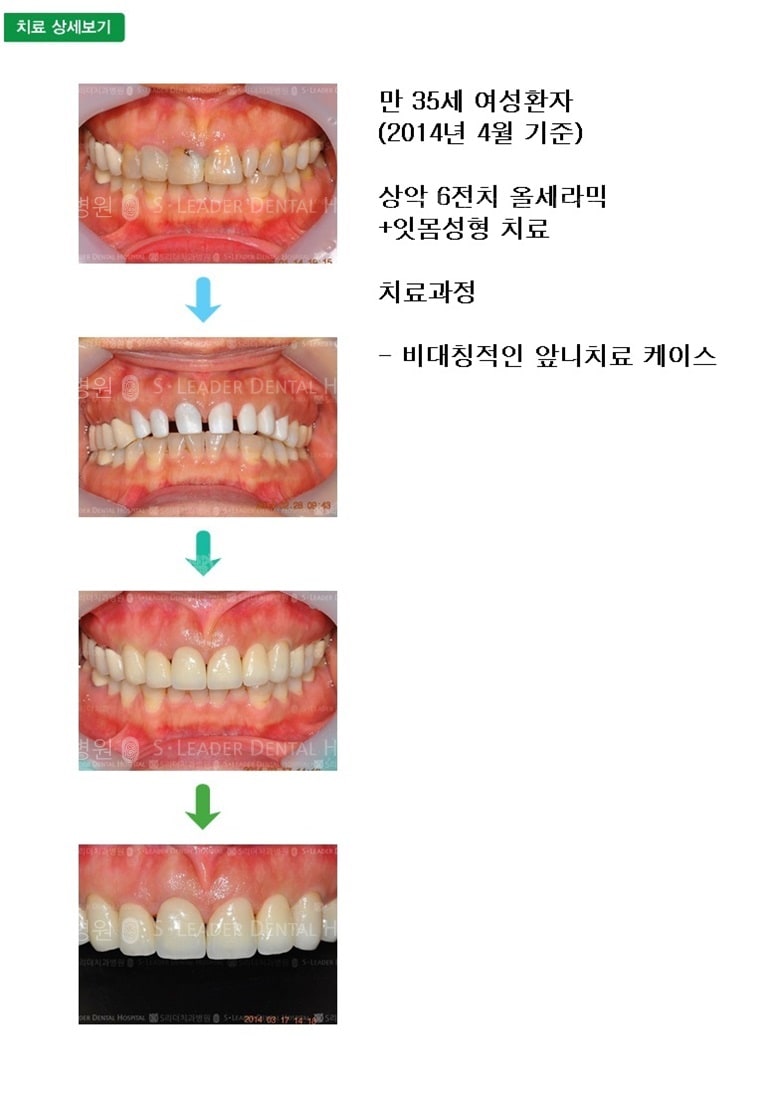 만 35세 여성환자, 앞니6개 치료 — 추가 사진 (심미보철)