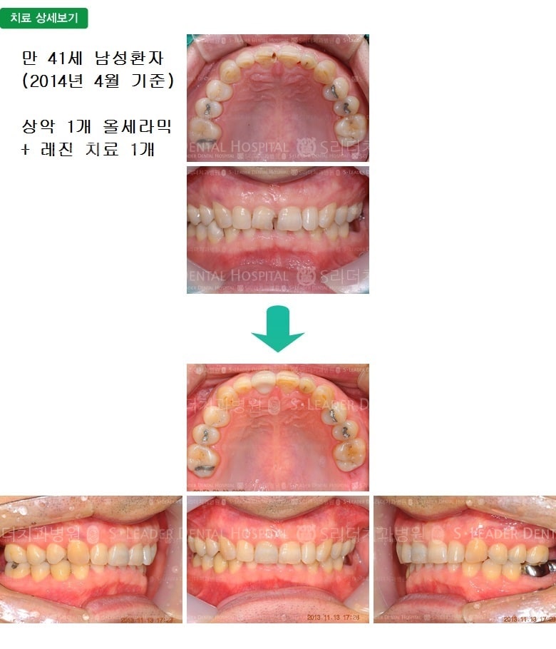 만 41세 남성환자, 앞니1개 + 레진1개 — 추가 사진 (심미보철)