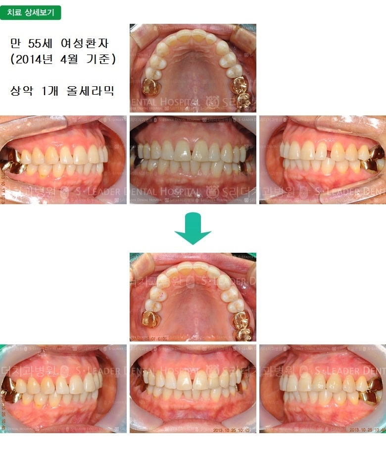 변색된 앞니의 치료, 만25세 남성환자 (증례 91)