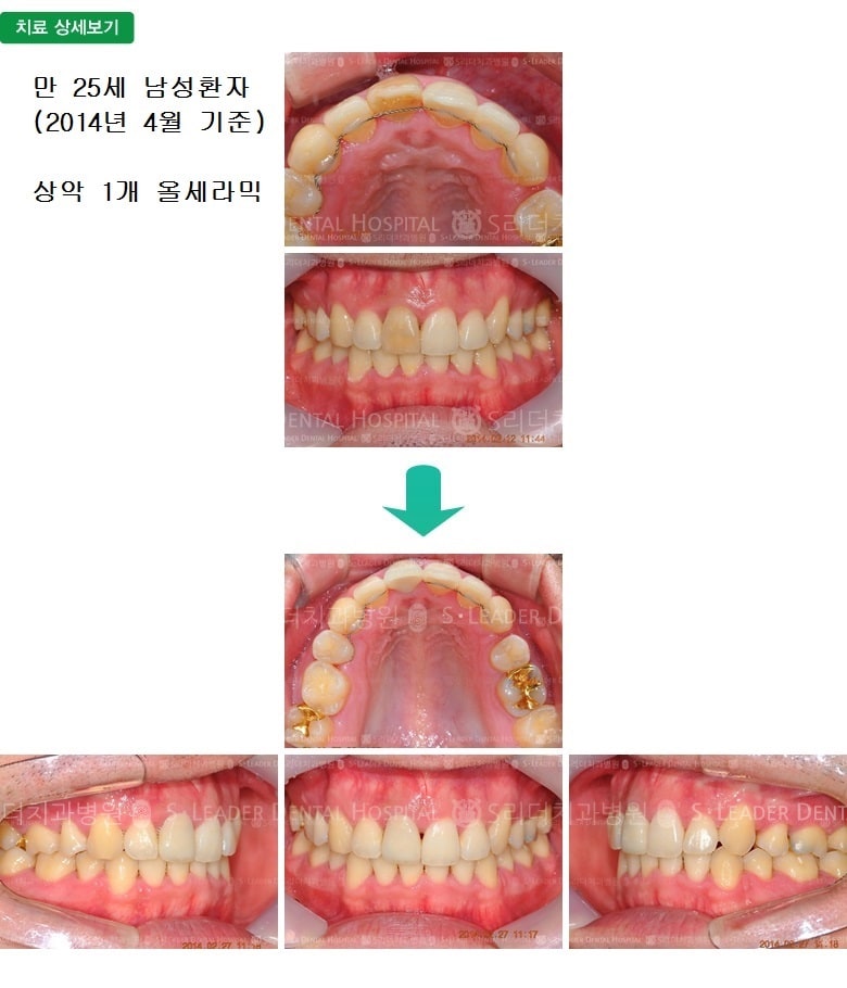 변색된 앞니의 치료, 만25세 남성환자 — 추가 사진 (심미보철)