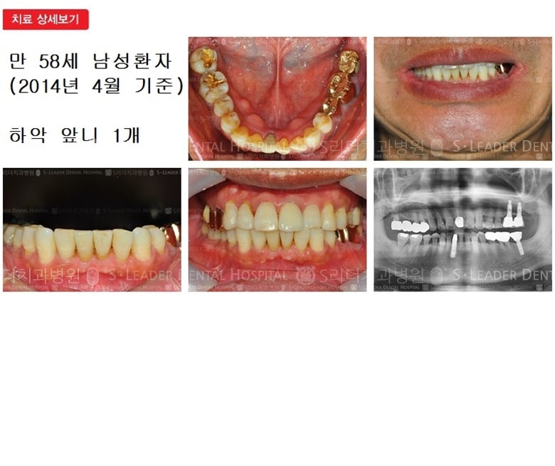 만 58세 남자환자, 앞니임플 — 추가 사진 (심미보철)