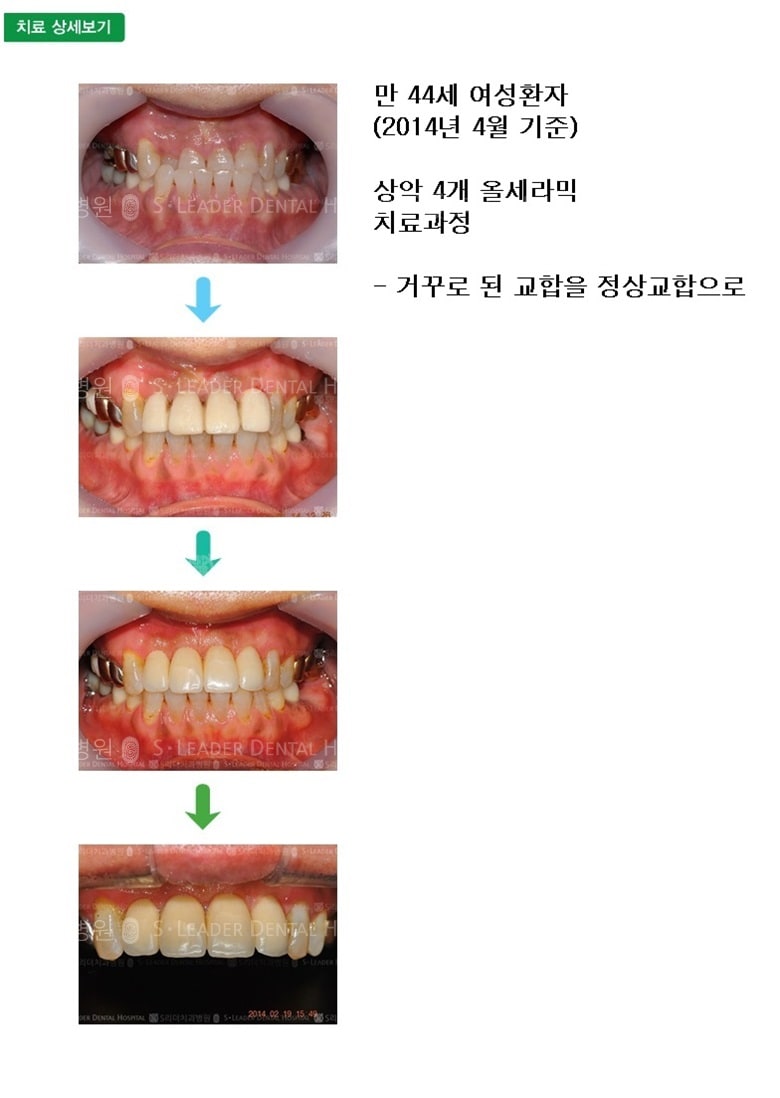 만 44세 여성환자, 앞니 4개 치료 — 추가 사진 (심미보철)