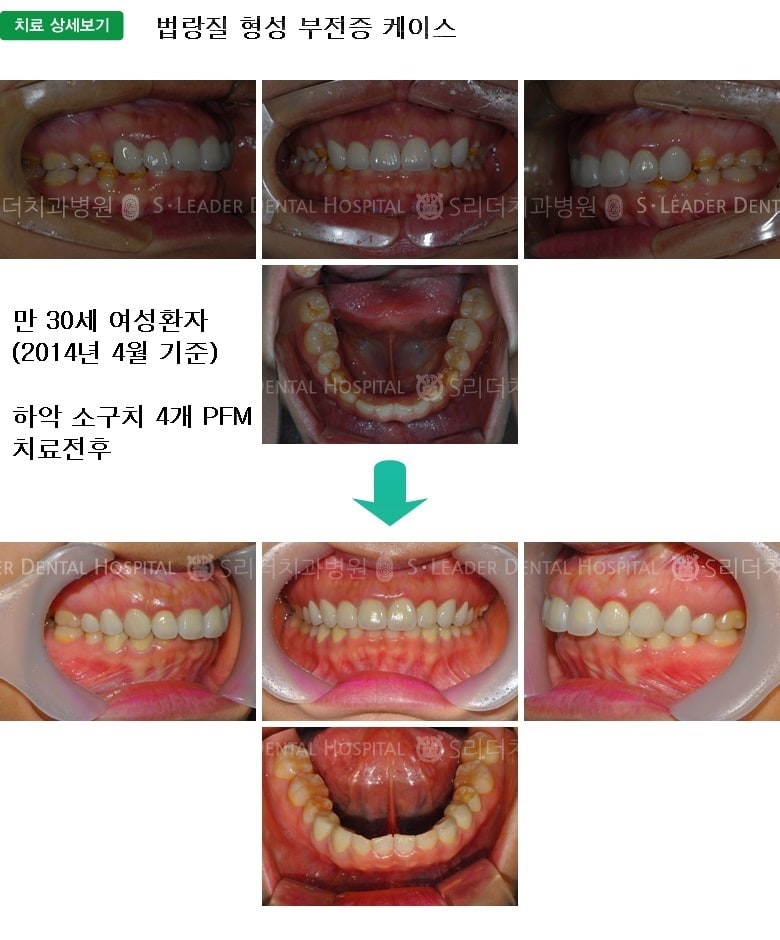 만 30세 여성환자,하악소구치4개 — 추가 사진 (심미보철)
