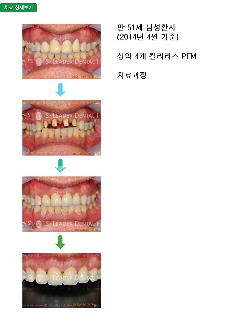 만 51세 남성환자,상악4개 칼라리스 PFM — 추가 사진 (심미보철)