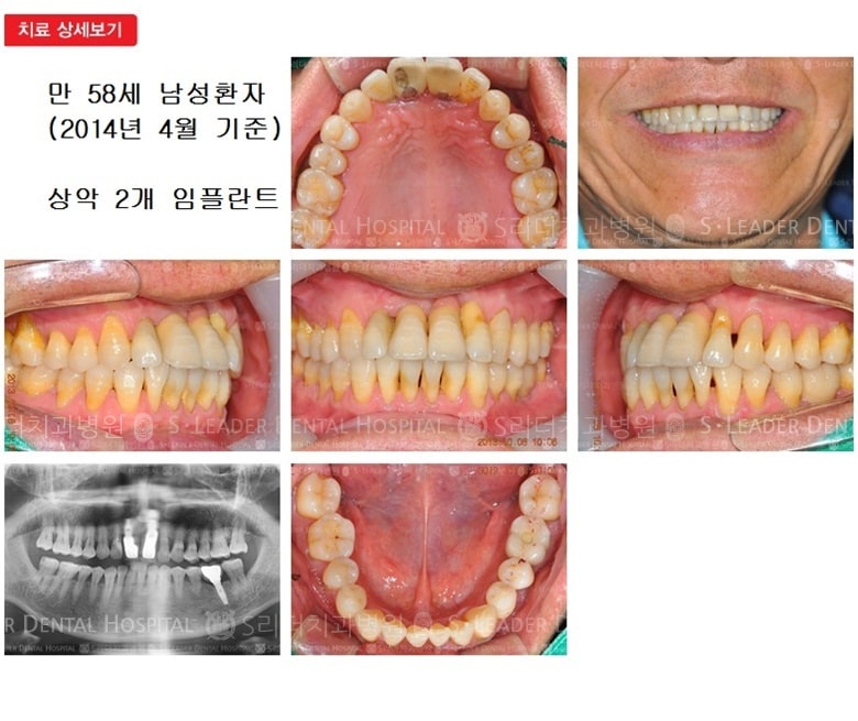 만 65세 남자환자,앞니환자 — 추가 사진 (심미보철)