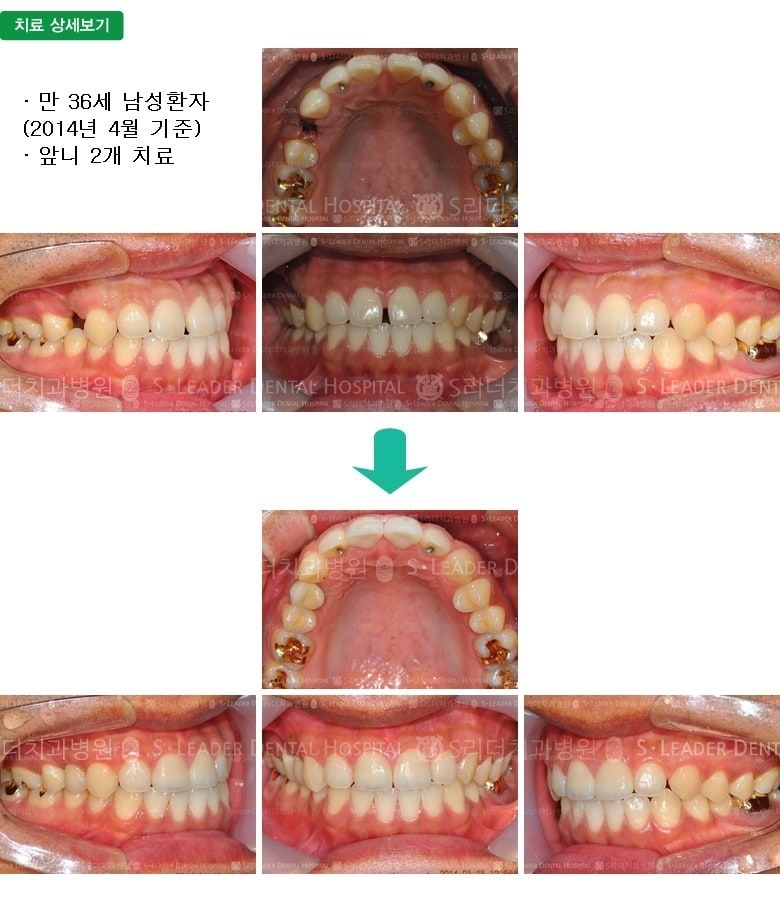 상악 앞니 2개 — 추가 사진 (심미보철)