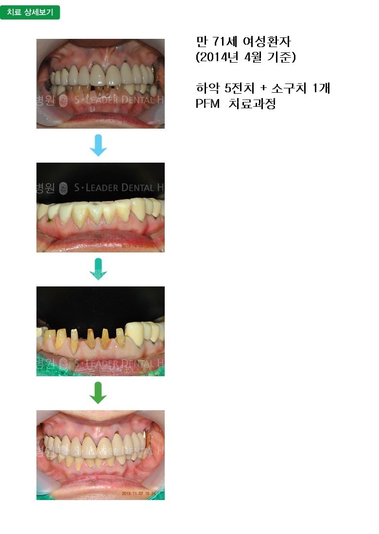 만 71세 여자환자, 하악6개치료 — 추가 사진 (심미보철)