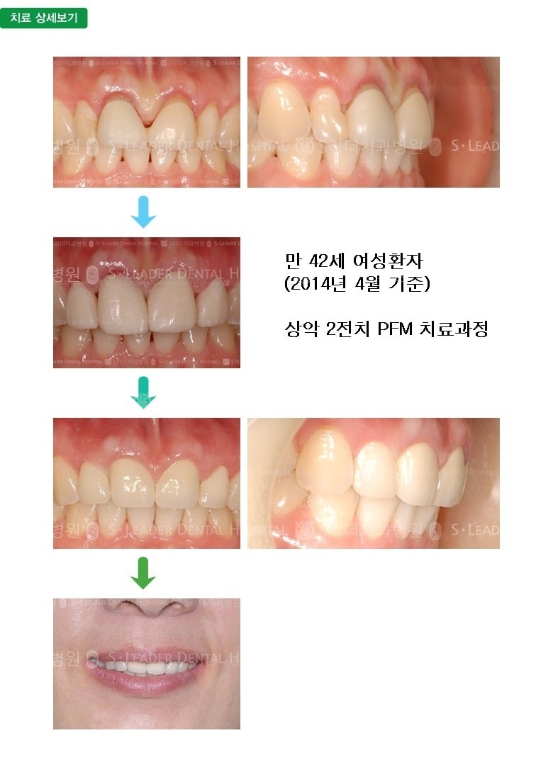 만 42세 여성환자, 앞니2개치료 — 추가 사진 (심미보철)