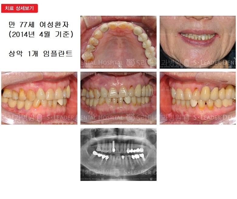 만 77세 여자환자,상악1개임플 — 추가 사진 (심미보철)