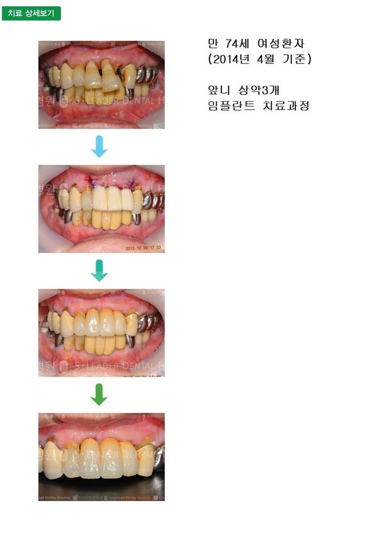 만 74세 여자환자,상악3개 — 추가 사진 (심미보철)
