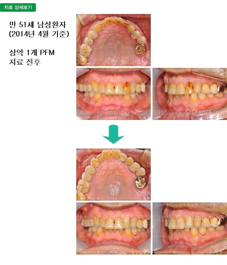 만 51세 남자환자,상악1개치료 — 추가 사진 (심미보철)