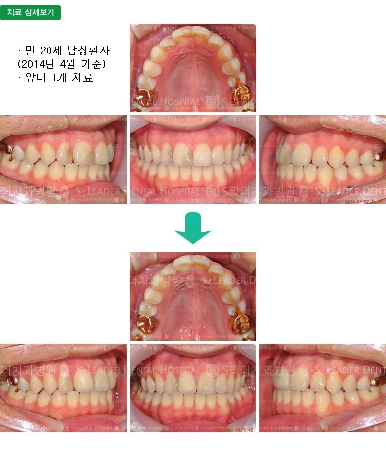 상악 앞니 1개 — 추가 사진 (심미보철)