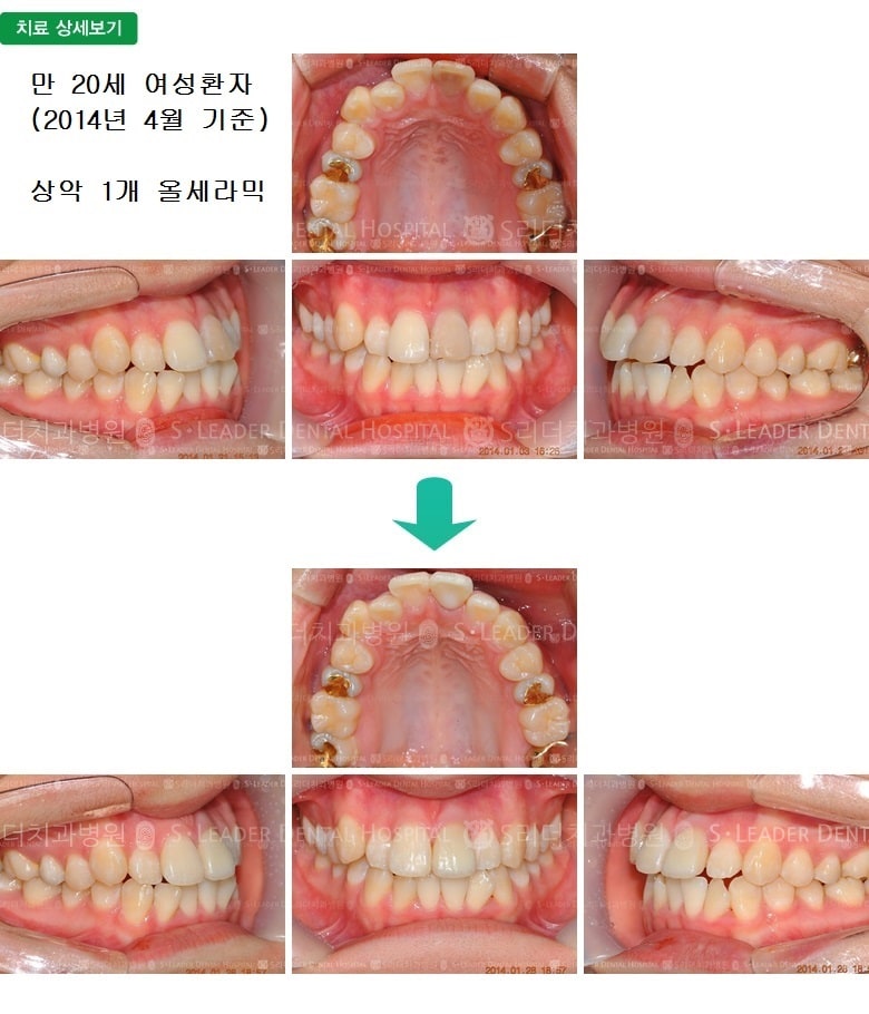 만 20세 여성환자, 앞니1개 치료 — 추가 사진 (심미보철)