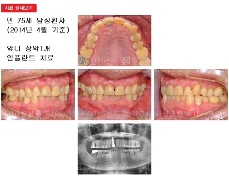 만 75세 남자환자,상악1개 — 추가 사진 (심미보철)