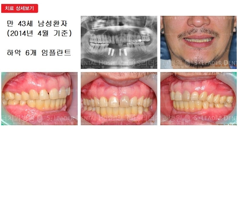 만 43세 남자환자,하악6전치 — 추가 사진 (심미보철)