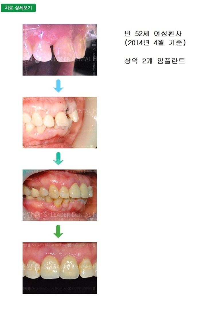 만 52세 여성환자, 상악임플 — 추가 사진 (심미보철)
