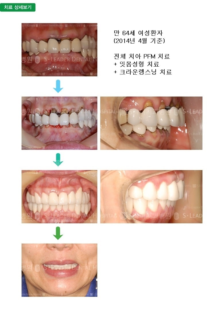 만64세 여성환자,전악PFM치료 — 추가 사진 (심미보철)