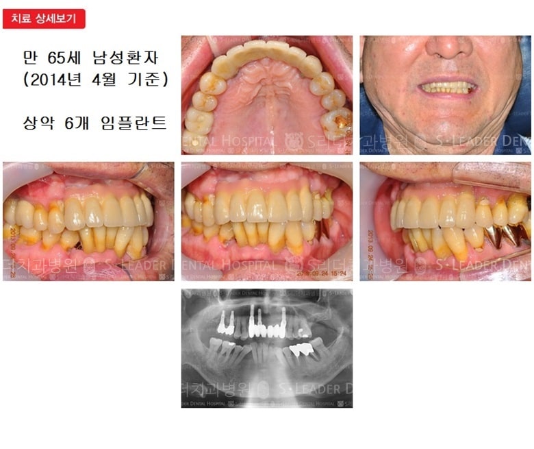 만 65세 남성환자,상악6개 — 추가 사진 (심미보철)