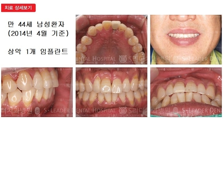 만 44세 남성환자,상악1개임플 — 추가 사진 (심미보철)
