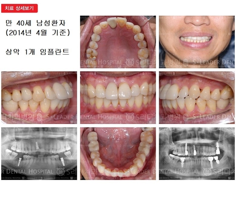만 40세 남자환자, 상악1개치료 — 추가 사진 (심미보철)