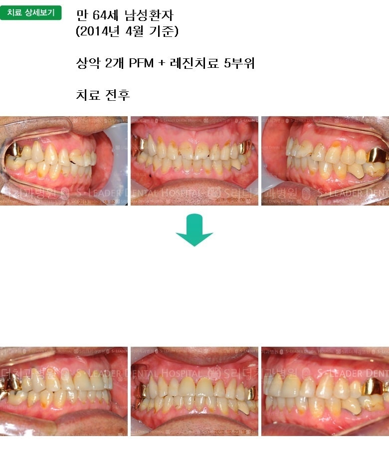 만 64세 남자환자, 앞니2개치료 — 추가 사진 (심미보철)
