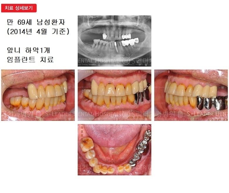 만 69세 남자환자,하악1개임플 — 추가 사진 (심미보철)