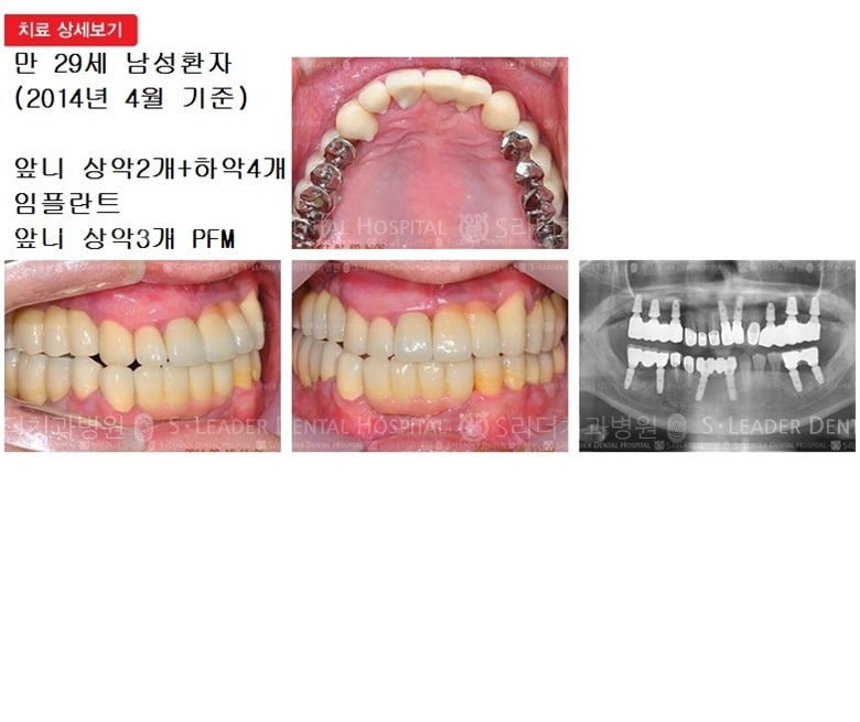 만 29세 남자환자,상악2개임플 — 추가 사진 (심미보철)