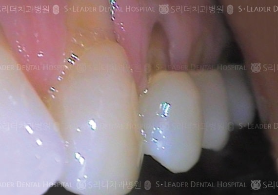 치경부 레진 치료 (증례 462)