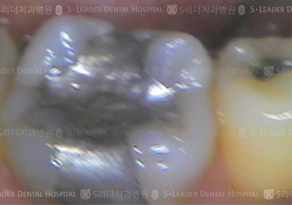 아말감 제거 후 골드 온레이 치료 (증례 475)