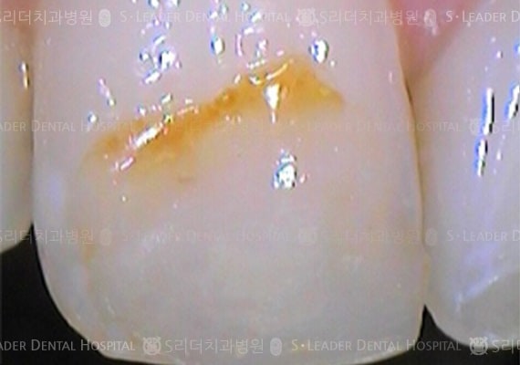 레진 순면 치료 (증례 468)