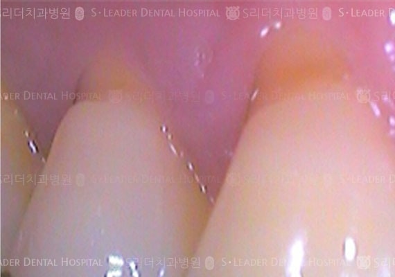 치경부 레진 치료 (증례 466)