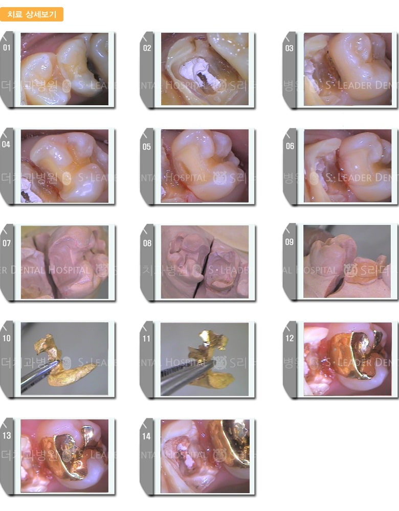 충치 제거 후 골드 인레이 치료 — 추가 사진 (일반진료)