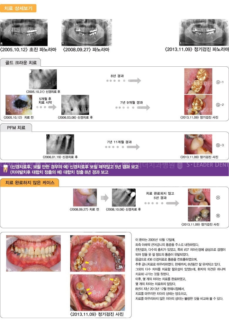 골드 크라운, PFM치료 — 추가 사진 (일반진료)