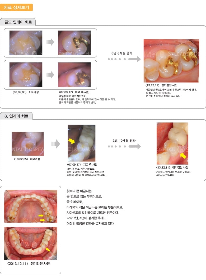 골드 인레이 치료, S.인레이 치료 — 추가 사진 (일반진료)