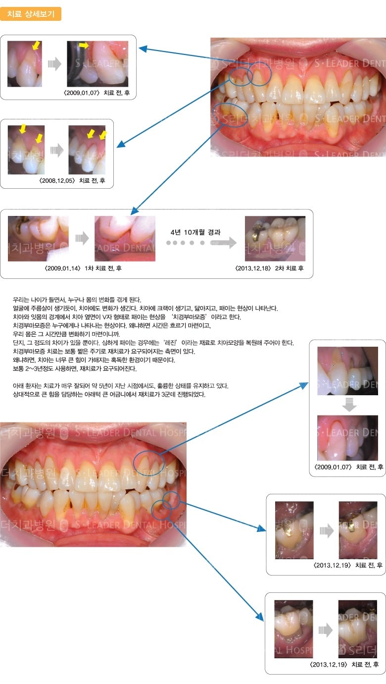 치경부 레진 치료 — 추가 사진 (일반진료)
