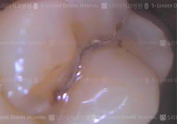 충치 제거 후 골드 인레이 치료 (증례 495)