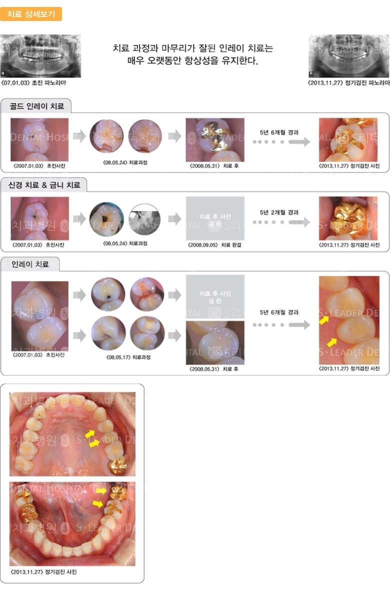 골드인레이, 신경치료&골드크라운치료 — 추가 사진 (일반진료)