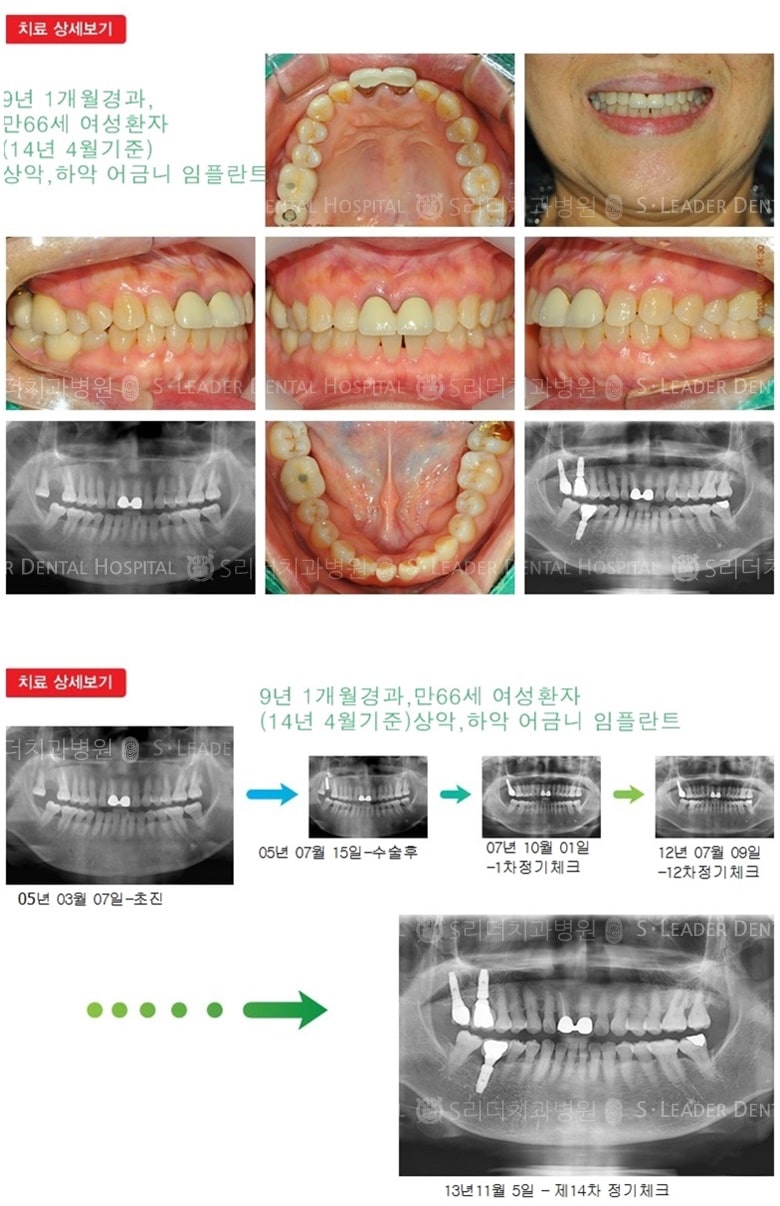 건강보험임플란트, 21년 6개월 경과 — 추가 사진 (임플란트)