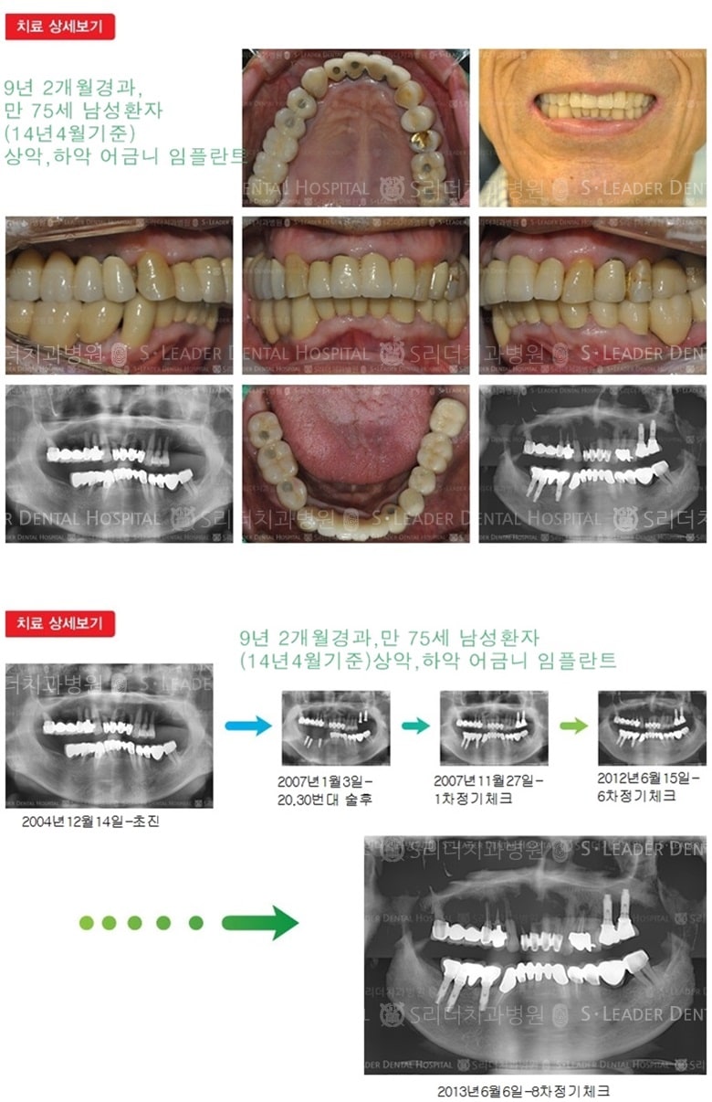 65세이상임플란트, 만75세, 21년 7개월경과 — 추가 사진 (임플란트)