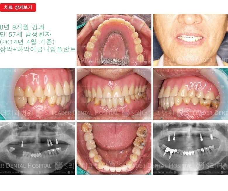 임플란트틀니, 21년 2개월 경과 — 추가 사진 (임플란트)
