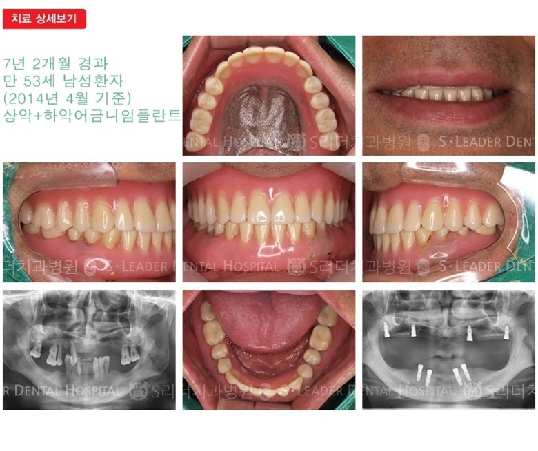 임플란트틀니, 19년 7개월 경과 — 추가 사진 (임플란트)